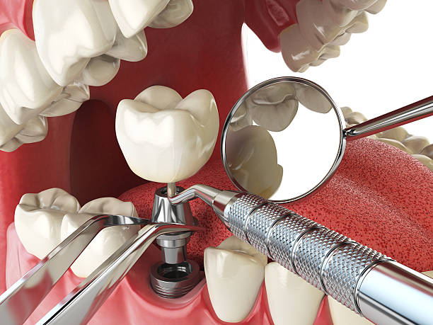 Best Lost Filling or Crown Replacement in Gulf Hills, MS